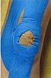 Kinesio Tape Knie - Heilpraktiker Peter Rocholl